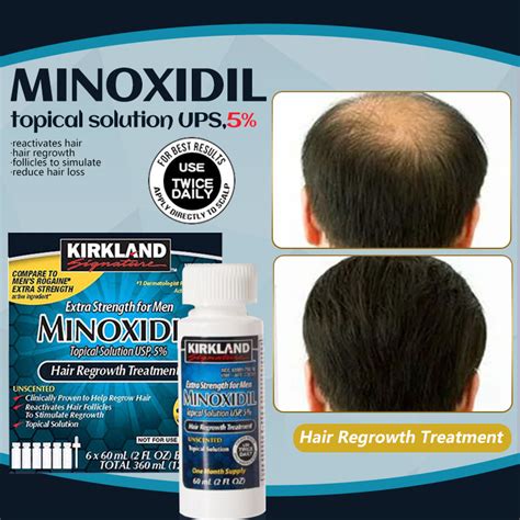 pampatubo ng buhok sa ulo|Alopecia .